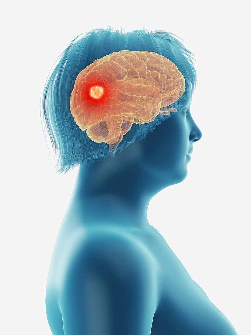 Illustration of a tumour in a woman's brain