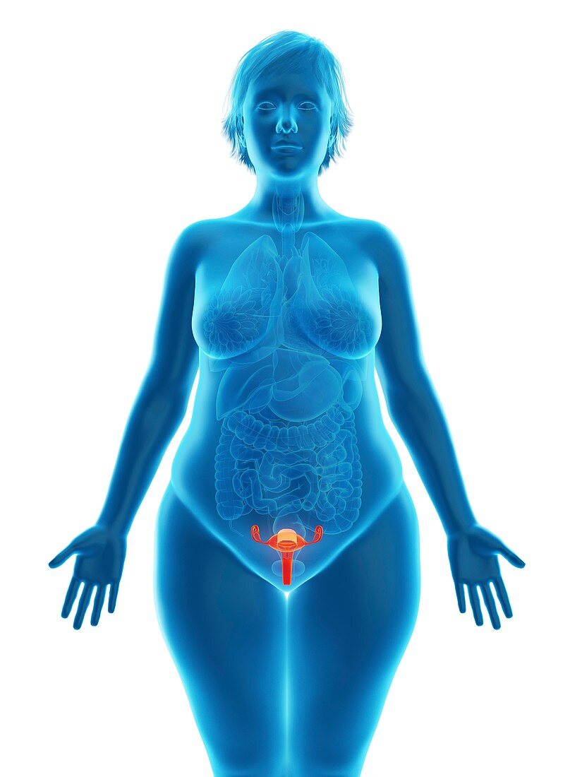 Illustration of an obese woman's uterus