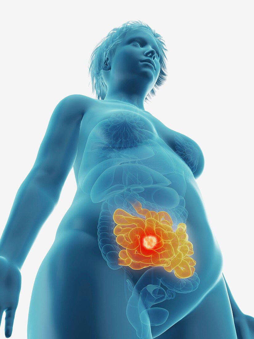 Illustration of a tumour in a woman's small intestine