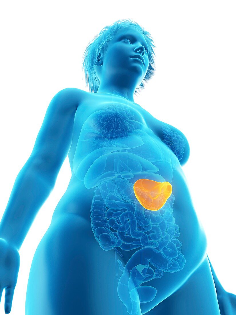 Illustration of an obese woman's spleen