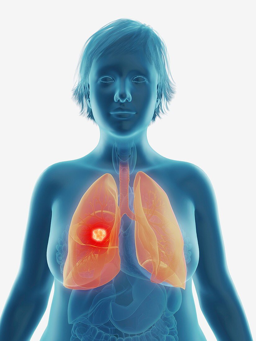 Illustration of a tumour in a woman's lung