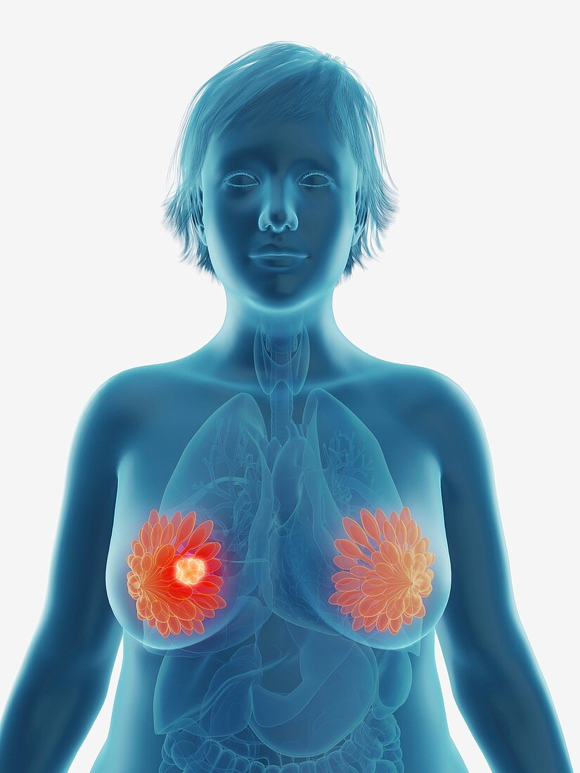 Illustration of a tumour in a woman's breast