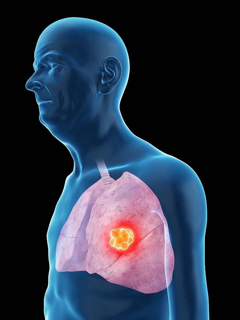 Illustration of an old man's lung cancer