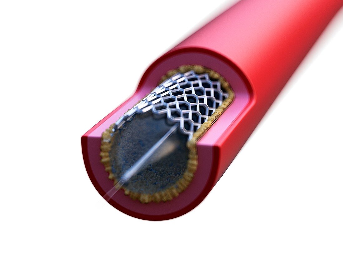 Illustration of stent placed in an artery