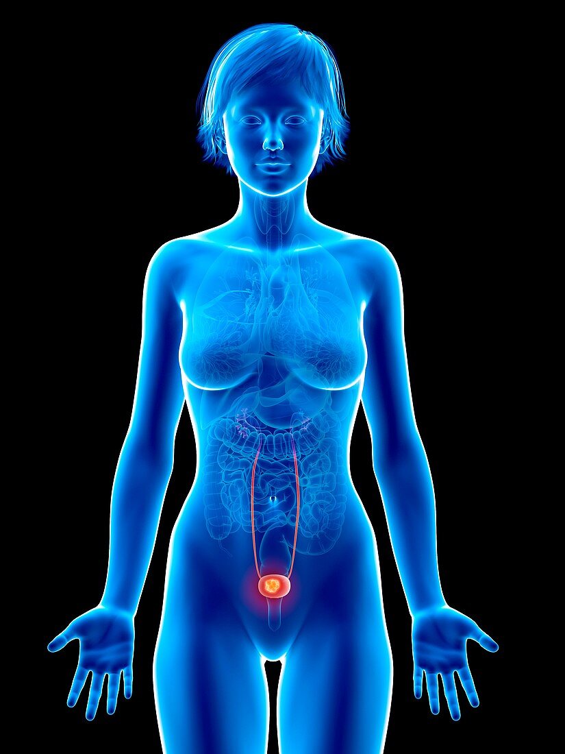 Illustration of bladder cancer