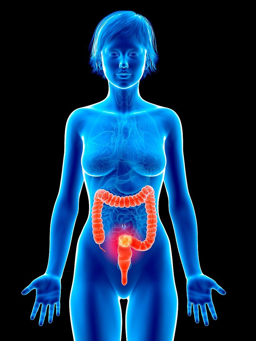 Illustration of colon cancer