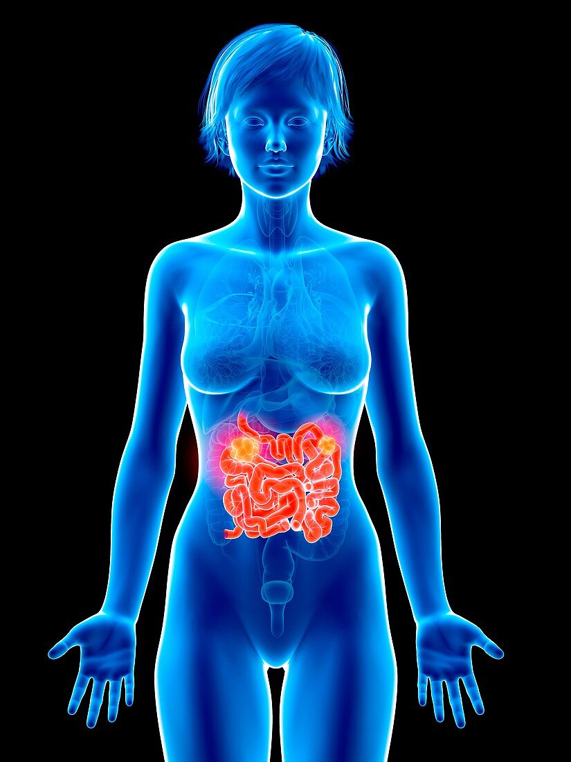 Illustration of small intestine cancer