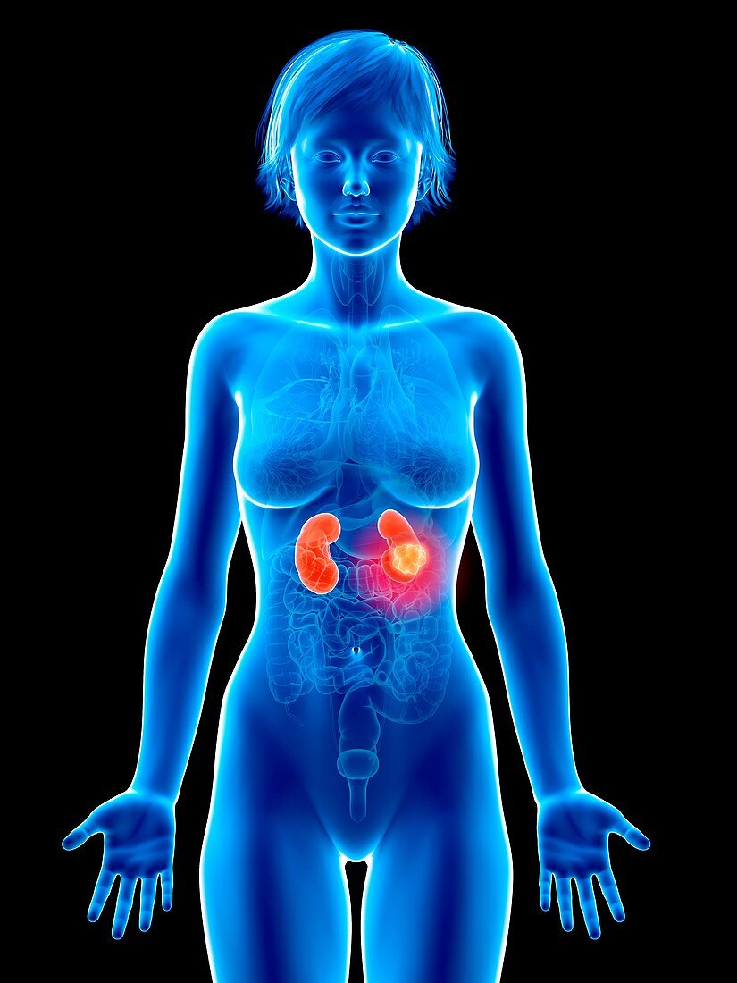 Illustration of kidneys cancer