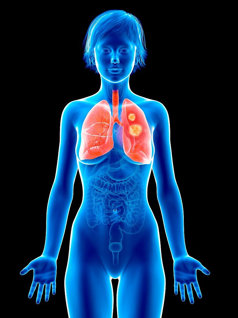 Illustration of lung cancer