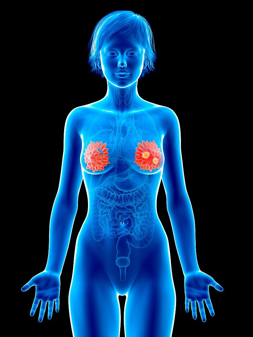 Illustration of mammary glands cancer