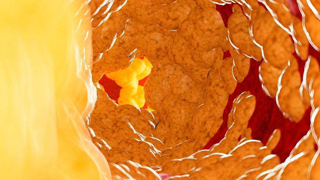 Illustration of fat inside of an artery