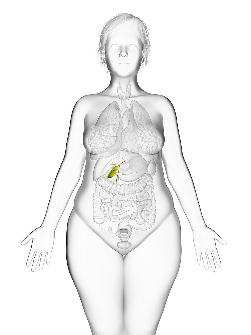 Illustration of an obese woman's gallbladder