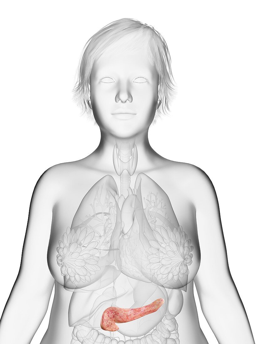 Illustration of an obese woman's pancreas