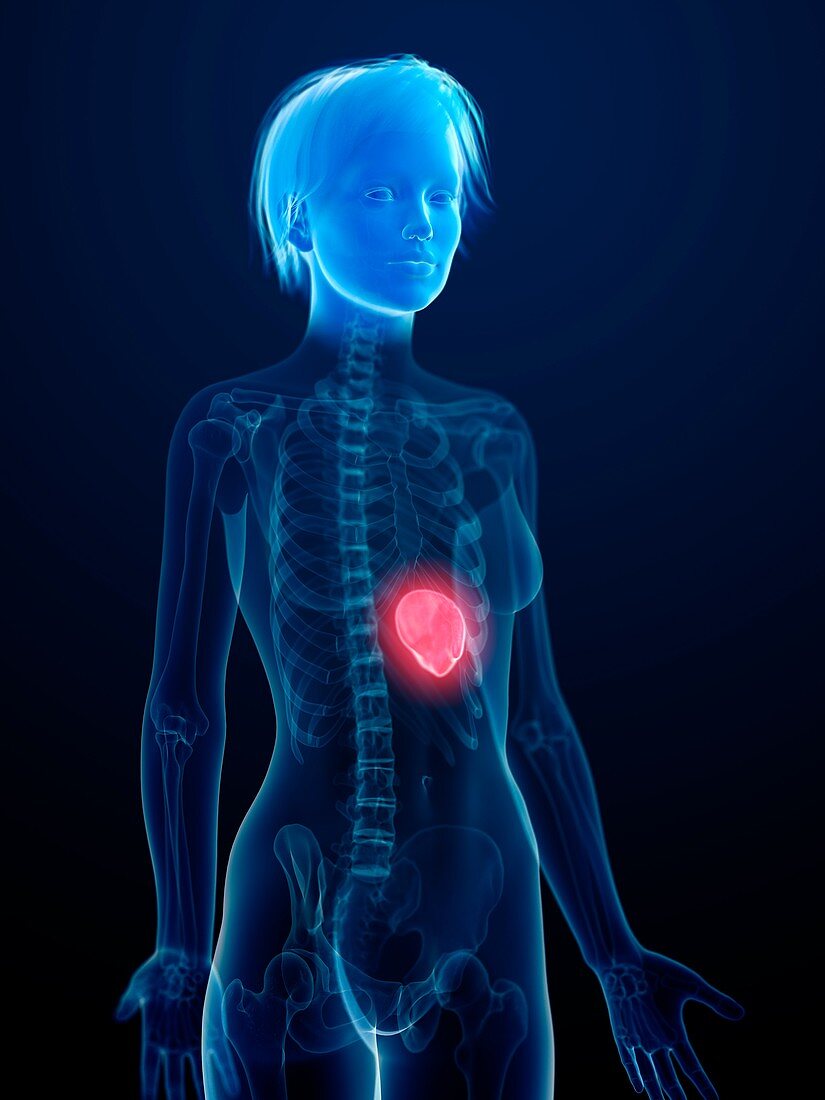 Illustration of an inflamed spleen