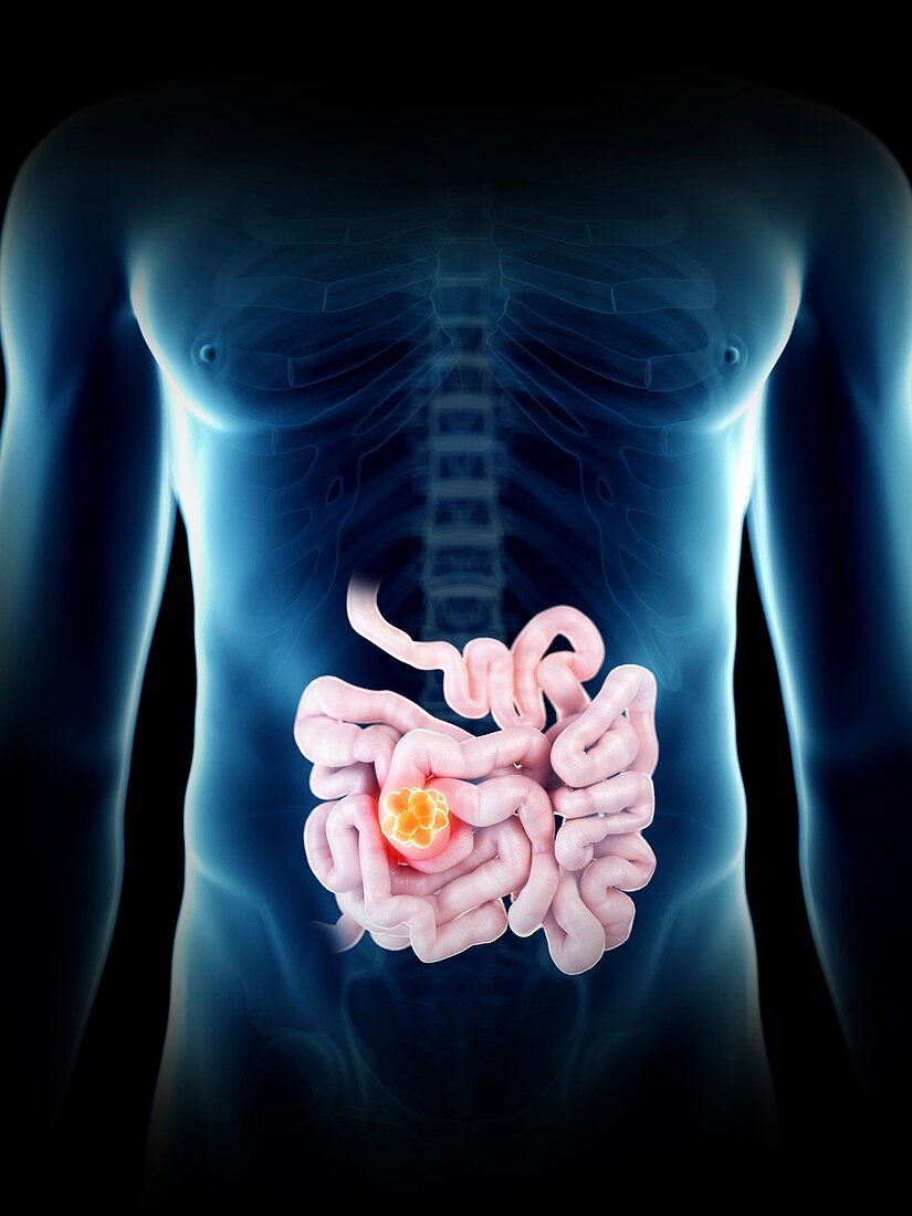 Illustration of a man's small intestine tumour