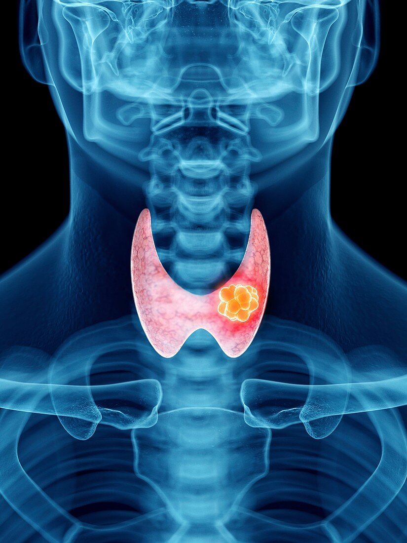 Illustration of a man's thyroid tumour