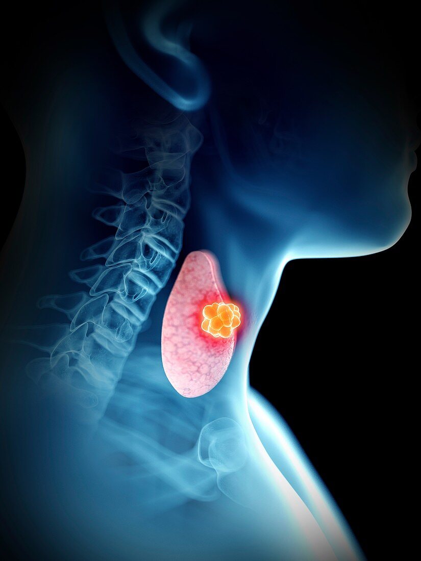 Illustration of a man's thyroid tumour