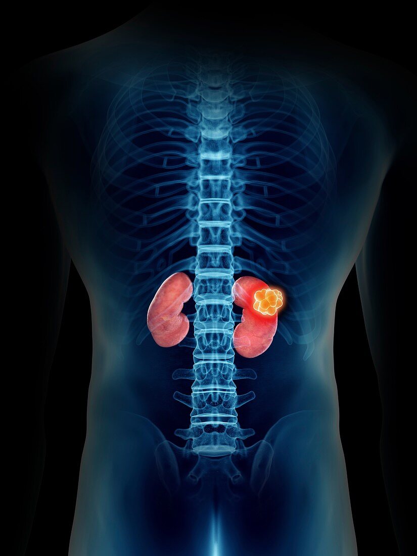 Illustration of a man's kidney tumour