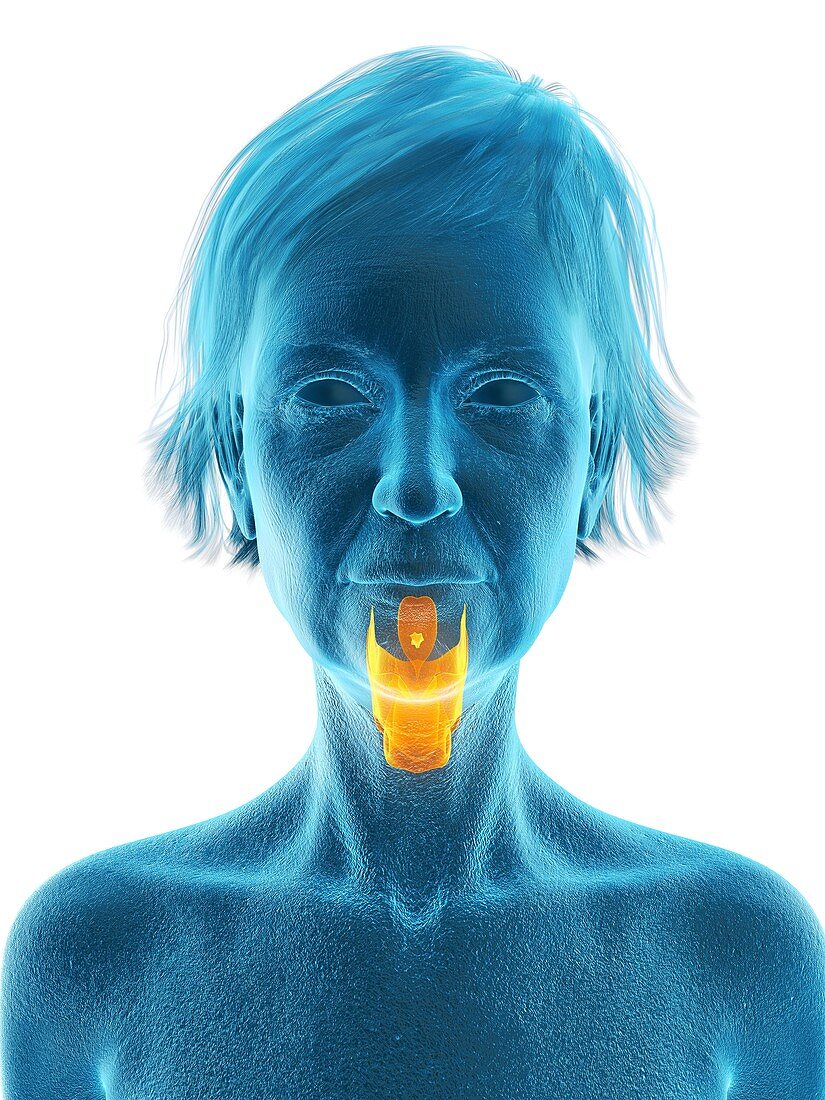 Illustration of an old woman's larynx