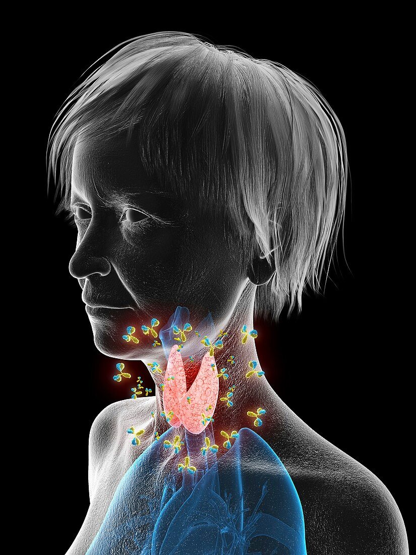 Illustration of autoimmune thyroid disease