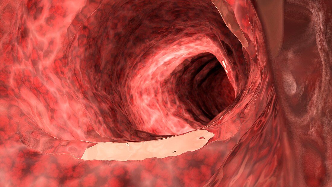 Illustration of an inflamed colon