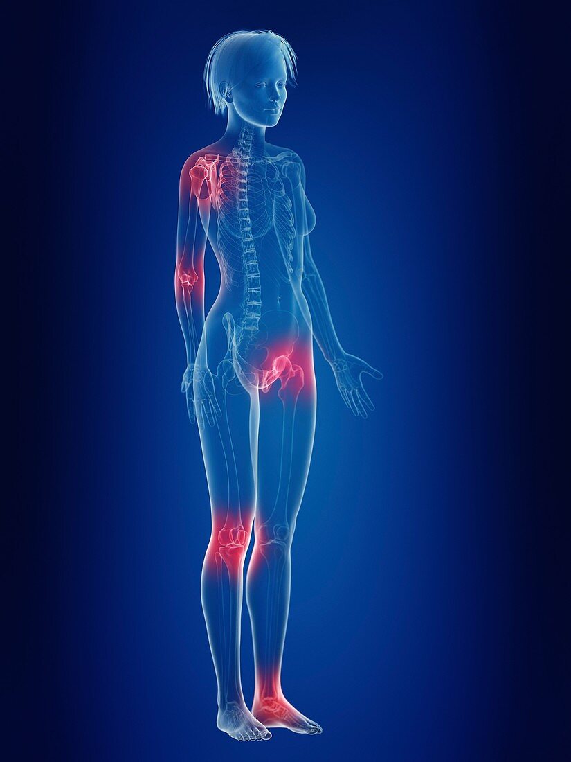 Illustration of a woman's painful joints