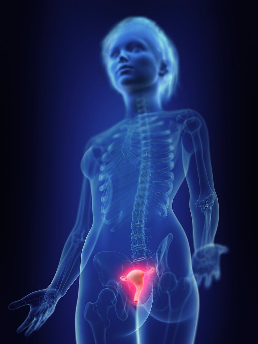 Illustration of an inflamed uterus