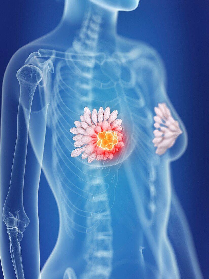 Illustration of a woman's mammary glands cancer