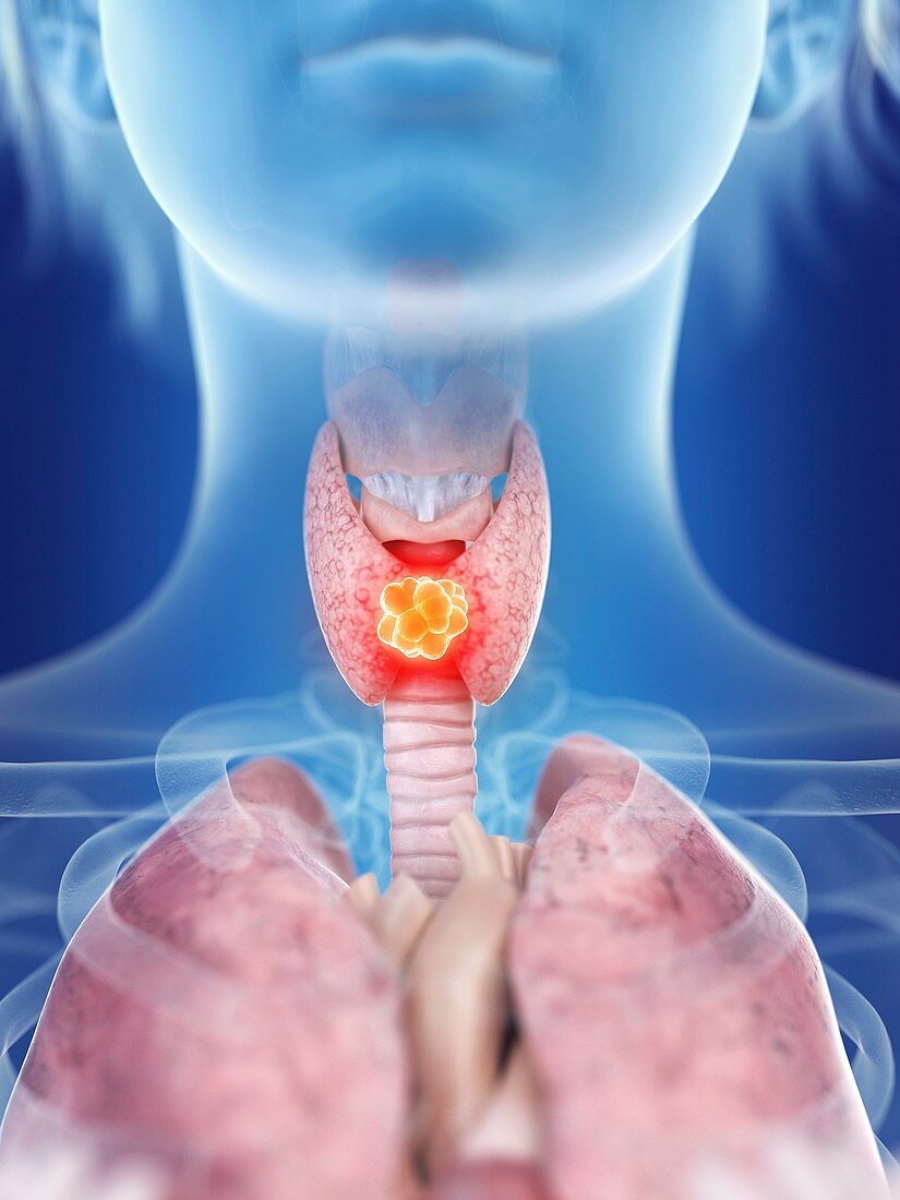 Illustration of a woman's thyroid gland cancer