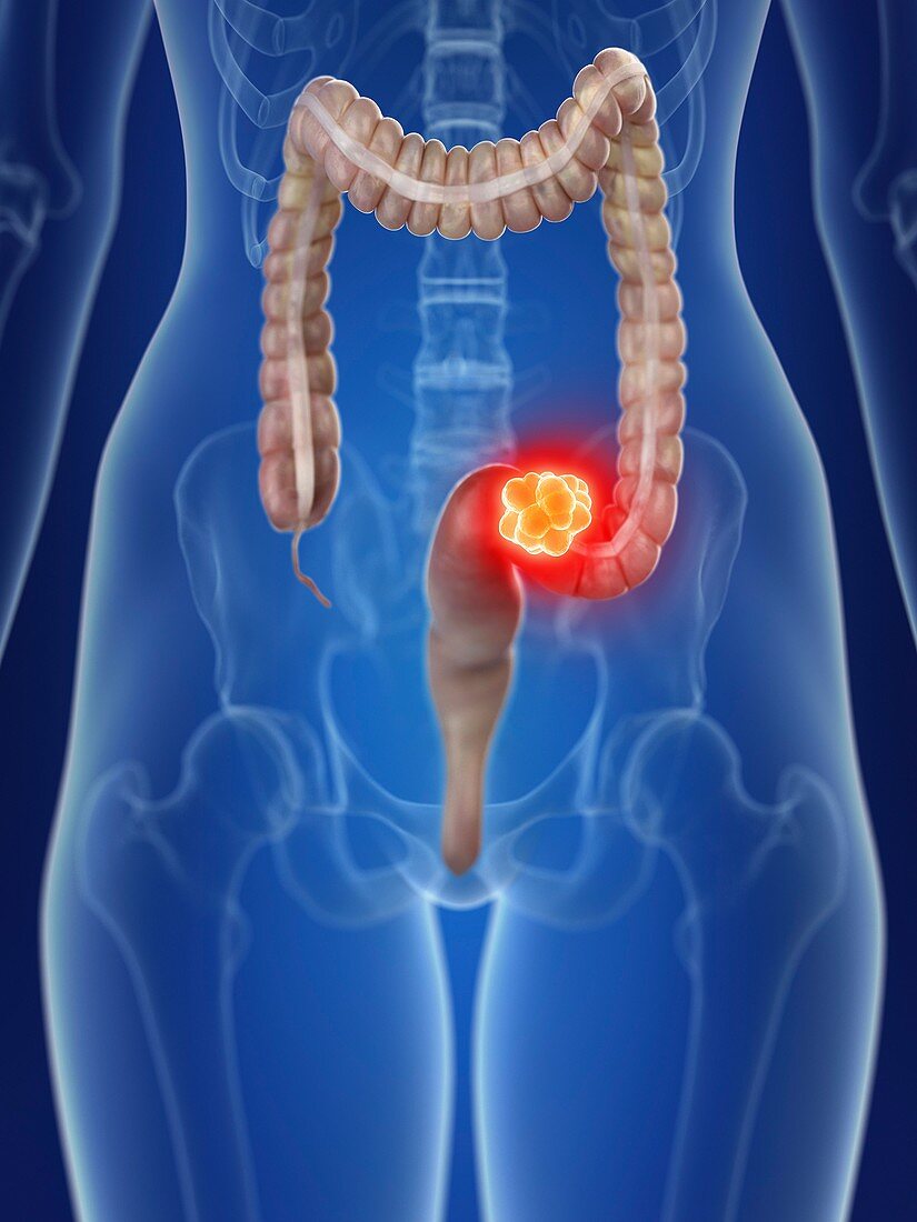 Illustration of a woman's colon cancer