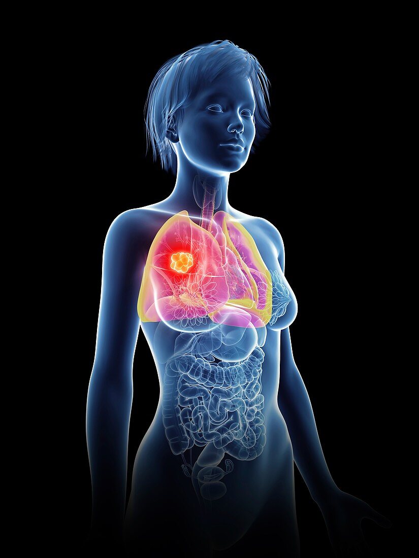 Illustration of a woman's lung cancer