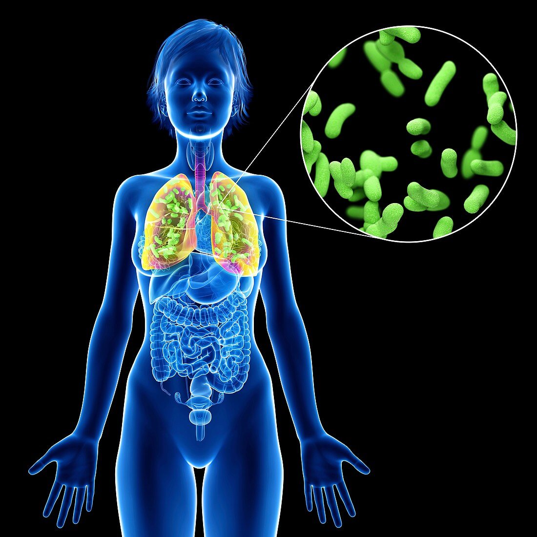 Illustration of a woman's lung infection