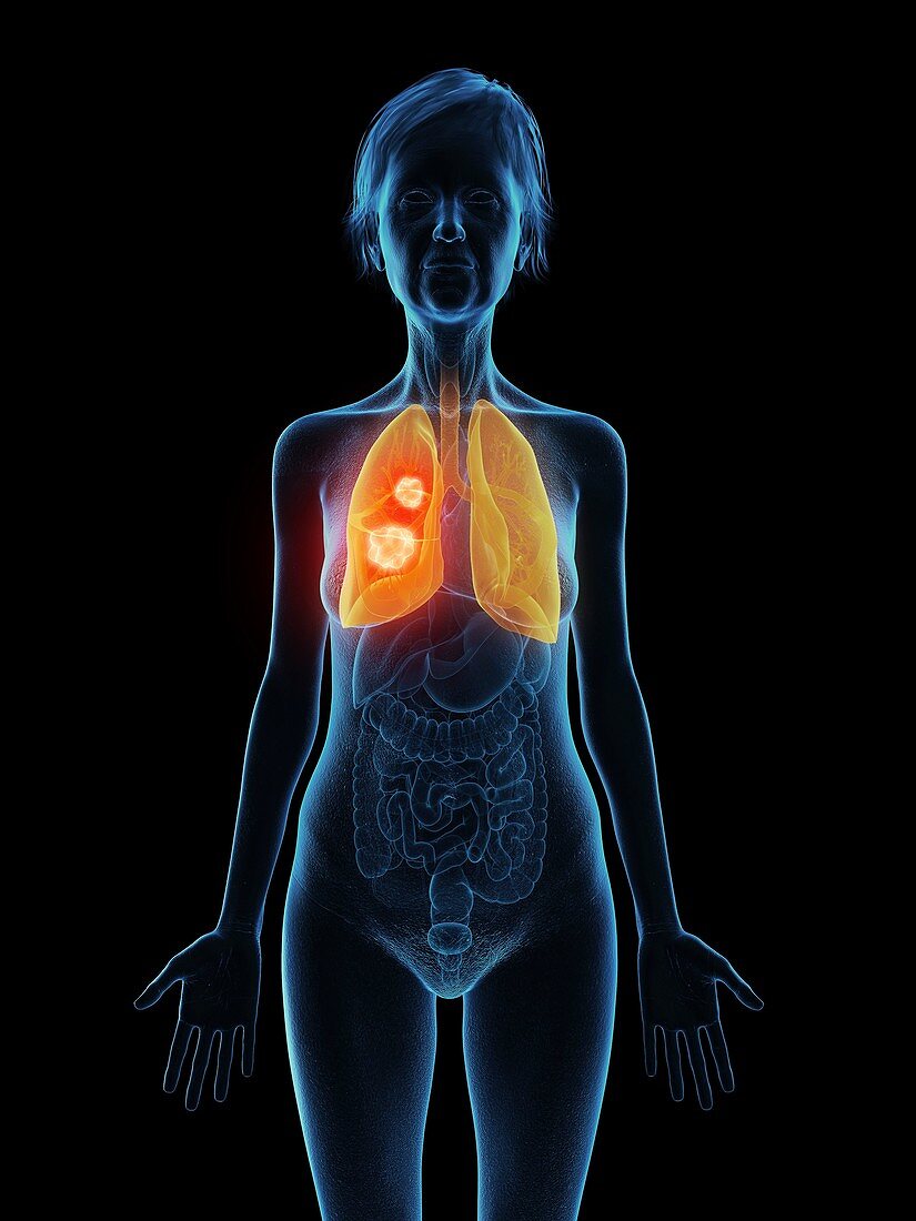 Illustration of an old woman's lung tumour