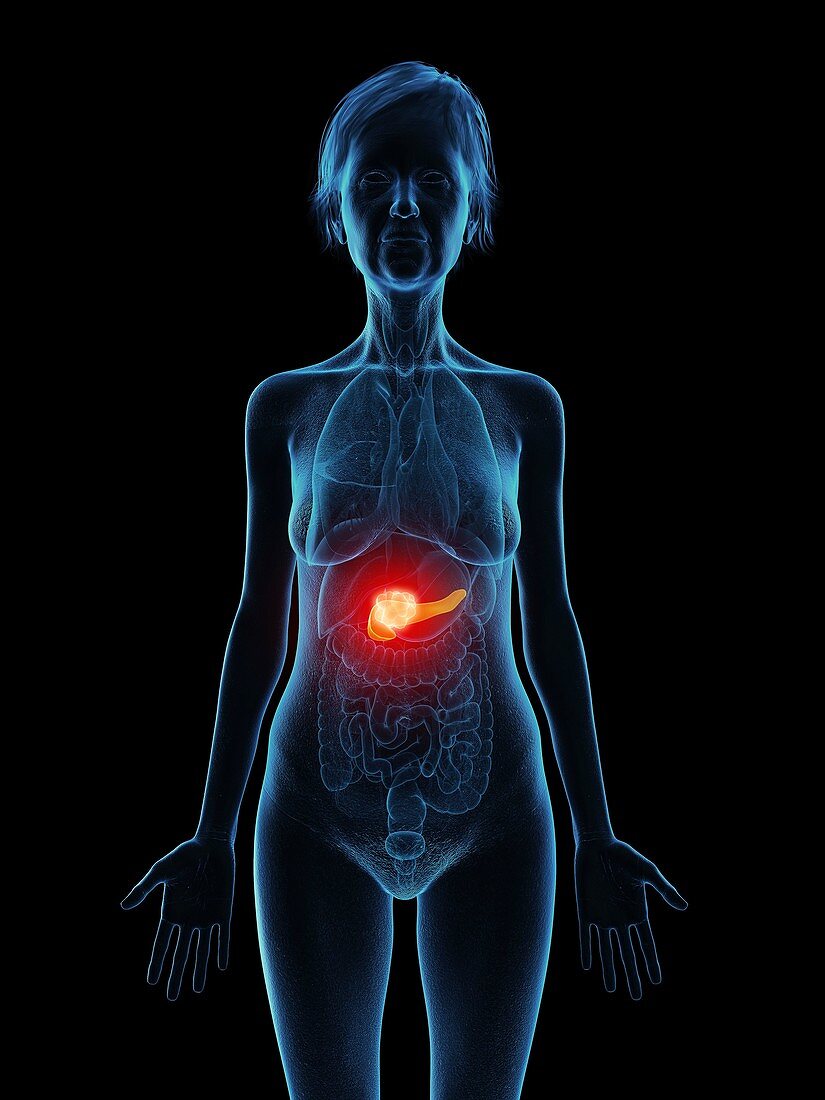 Illustration of an old woman's pancreas tumour