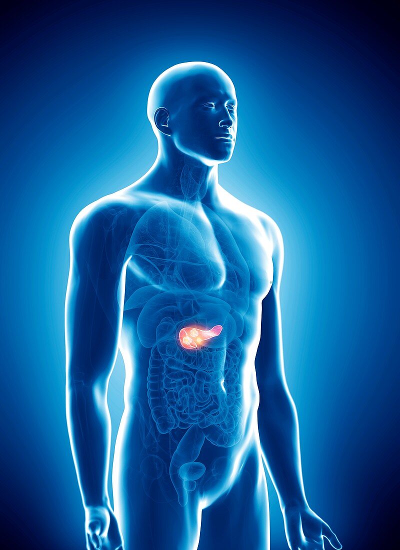 Illustration of pancreas cancer