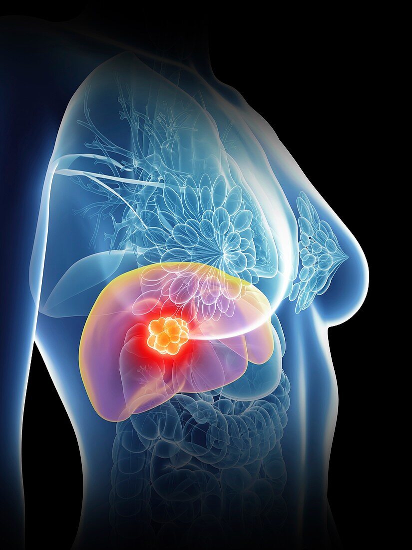 Illustration of a woman's liver cancer