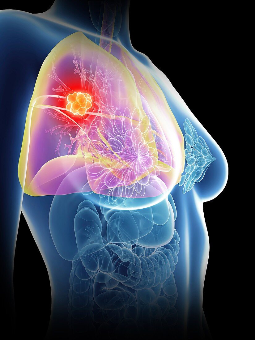 Illustration of a woman's lung cancer