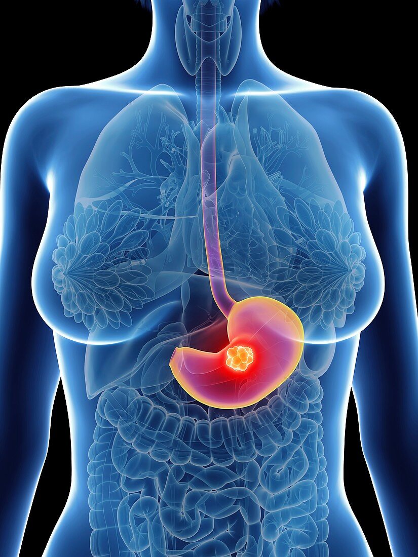 Illustration of a woman's stomach cancer