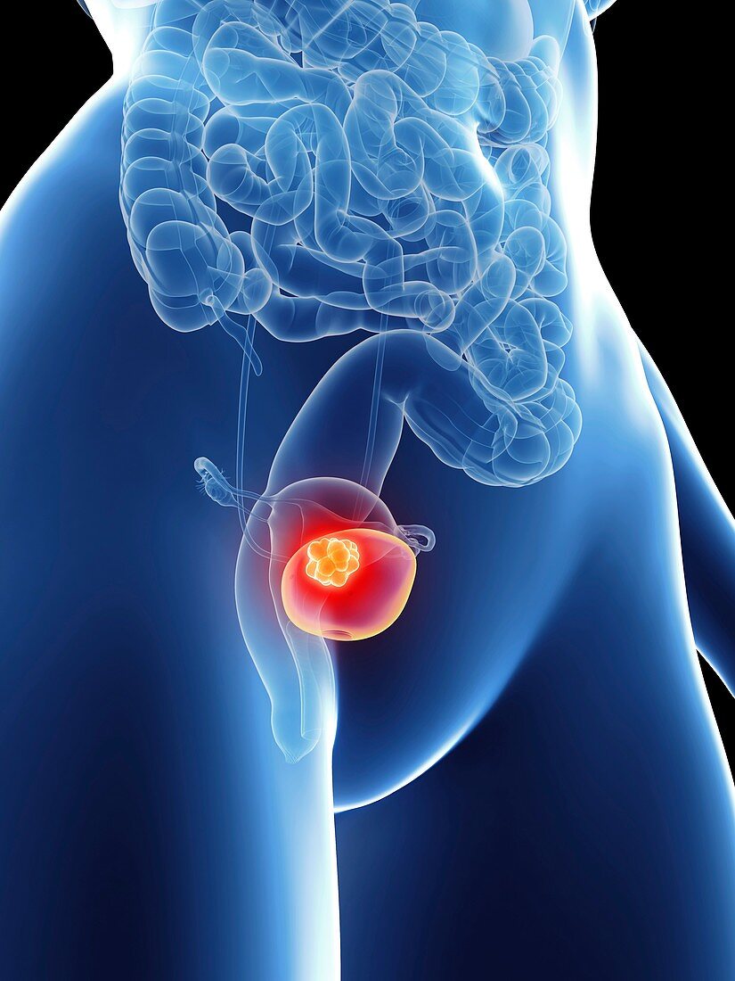 Illustration of a woman's bladder cancer