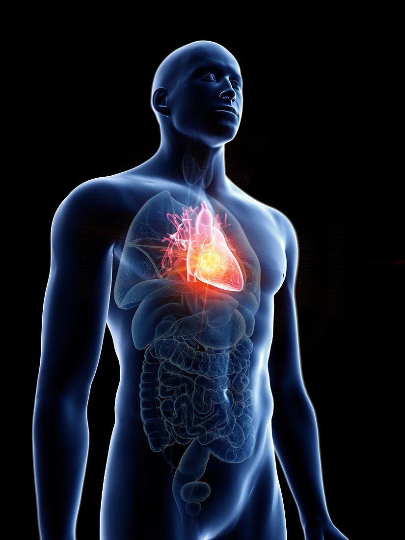 Illustration of a man's heart tumour