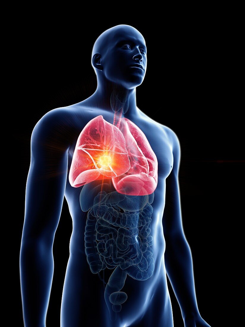 Illustration of a man's lung tumour