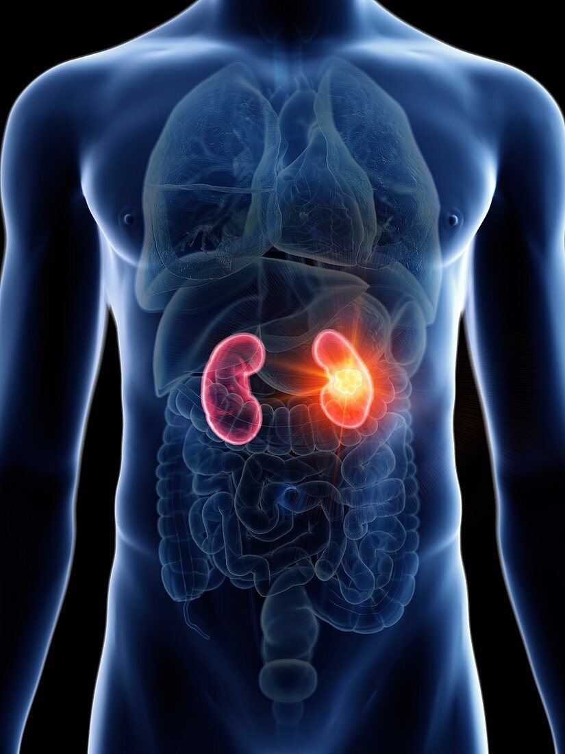 Illustration of a man's kidneys cancer