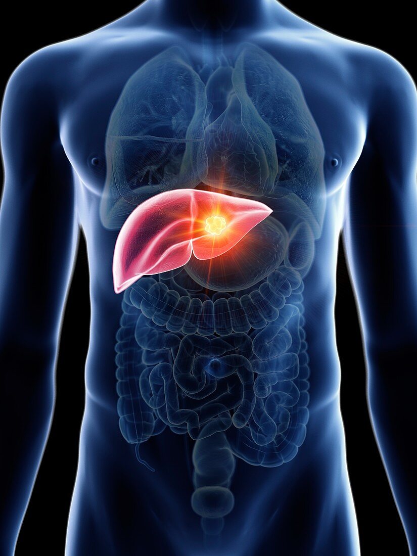 Illustration of a man's liver cancer