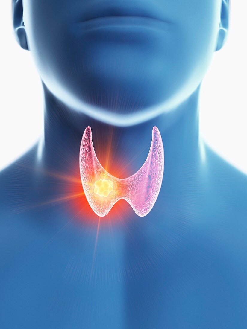 Illustration of a man's thyroid gland cancer