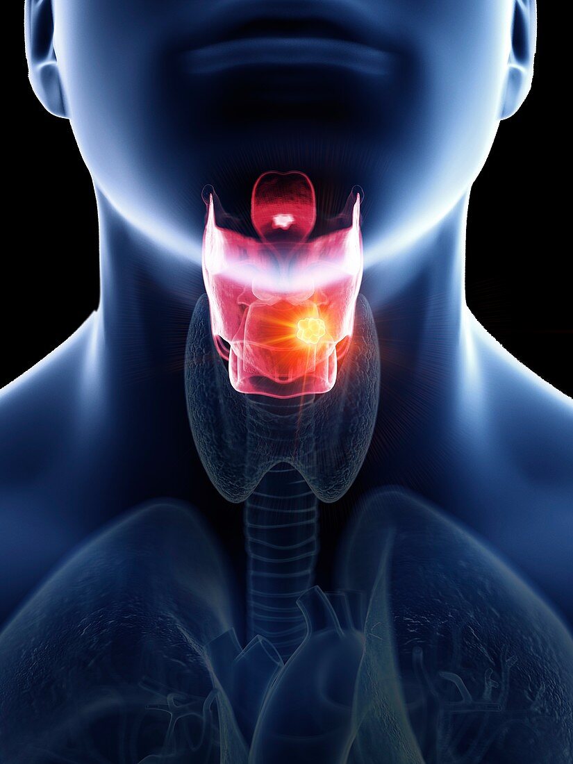 Illustration of a man's larynx cancer