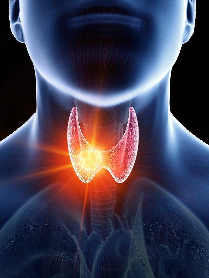 Illustration of a man's thyroid gland cancer