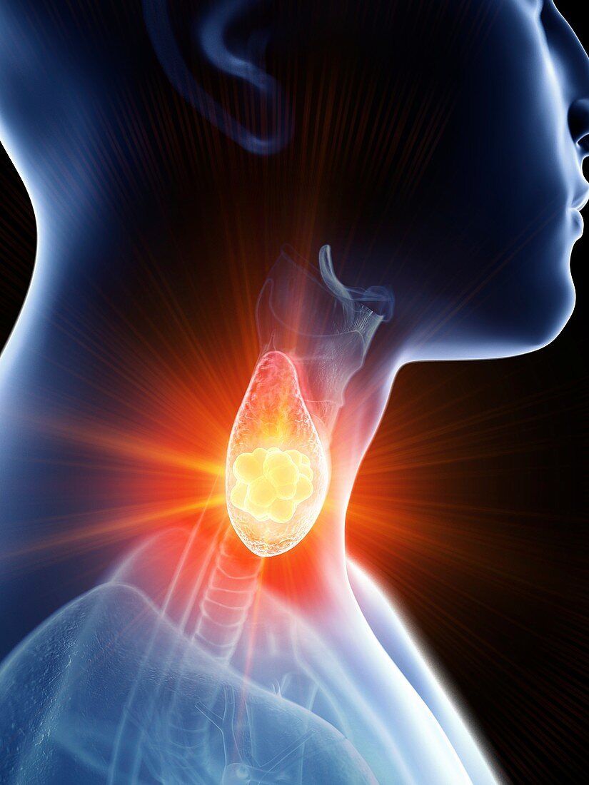 Illustration of a man's thyroid gland cancer