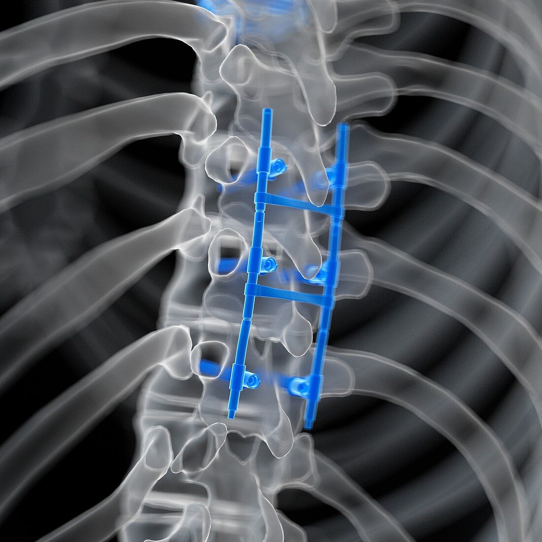 Illustration of a spinal fusion