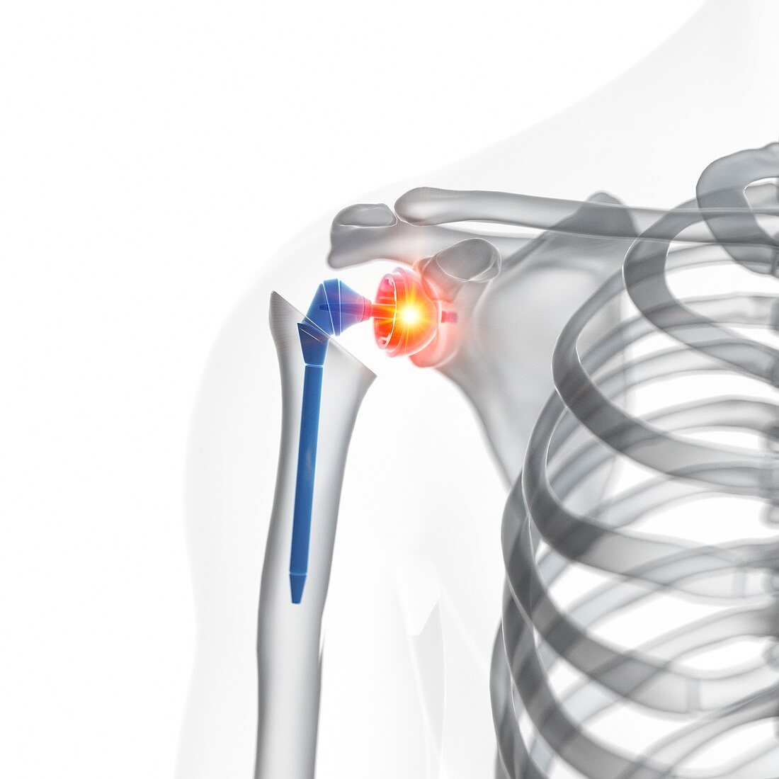 Illustration of a shoulder replacement