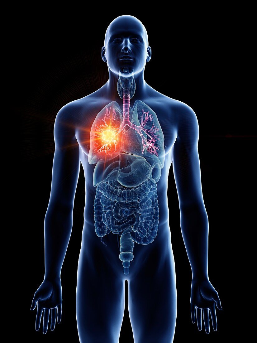 Illustration of a man's bronchi cancer